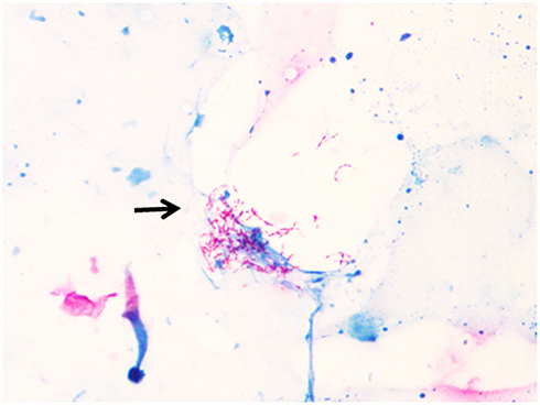 Figure 4 Acid-fast bacilli, slightly curved, with a tendency to branch (arrows) are observed on microscopy after the reversion test.