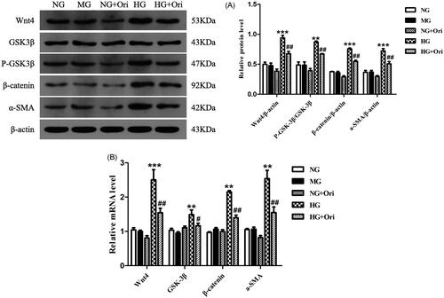 Figure 8. Expression of proteins in the Wnt/β-catenin signaling pathway in HG-treated HK-2 cells.(A) Protein expression levels of Wnt4, GSK3β, p-GSK3β, β-catenin and α-SMA in HK-2 cells. (B) qPCR analysis of the mRNA expression of Wnt4, GSK3β, β-catenin and α-SMA in HK-2 cells. **p < 0.01 vs. the NC or NG group, ***p < 0.001 vs. the NC or NG group, #p < 0.05 vs. the DN or HG group, ##p < 0.01 vs. the DN or HG group, and ###p < 0.001 vs. the DN or HG group. p-GSK3β, phospho-glycogen synthase kinase-3β; α-SMA: α-smooth muscle actin; qPCR: quantitative polymerase chain reaction.