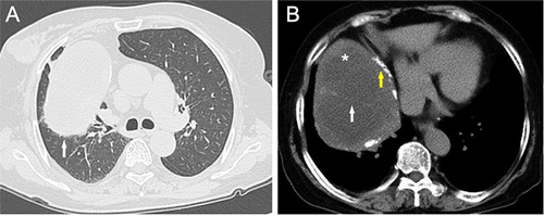 Figure 1 Enhanced CT showed that the tumor was located in the anterior mediastinum, presenting a mixed mass of cystic and solid, compressing the right lung (white arrow (A), lung window). The tumor boundary was clear ((B), mediastinal window), with arc-shaped calcification shadows (yellow arrow), solid components (asterisk), and internal septa (white arrow).