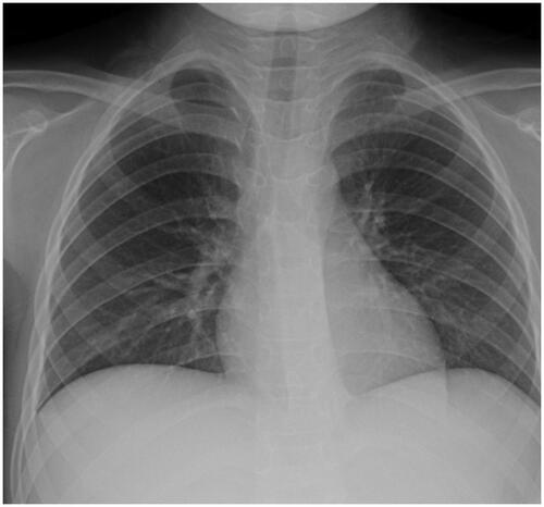 Figure 2. Chest radiograph of case 2.