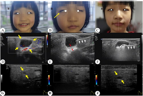 Figure 6. An 8-year-old girl with pleomorphic adenoma of the right parotid gland. A, B she had an askew mouth and couldn’t close the right eyelids one week after TA. C two months after TA, the patient recovered as usual. D Preoperative ultrasound images indicated a tumor at the right parotid gland. E Performed hydrodissection before TA. F Place the active tip of ablation needle at the distal end of the tumor, and then perform sectorial ablation from the bottom to the top. G 3 years after TA, the tumor had shrunk by more than 95%. H No obvious abnormal blood flow signal found in the right parotid gland. J No obvious blood flow signal found in the tumor. Yellow arrows indicated the edge of tumor; red arrows indicated separation zone; white arrows in figure E and F indicated the biopsy needle and the ablation needle respectively.