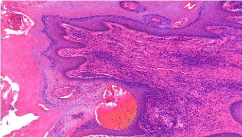 Figure 3. Giraffe skin disease section by HE staining showing a complex of fungal hyphae, chronic focal inflammation and extravasation of red blood cells (magnification of 10 times) [arrows].