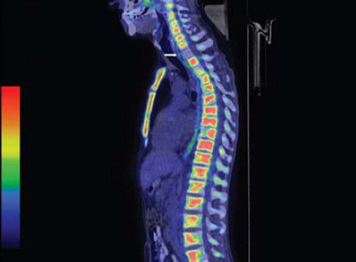 Figure 2. FDG-PET/CT showing lack of normal FDG-uptake in Th I in a patient with Hodgkin lymphoma after two courses of BEACOPP-14, indicating previous lymphoma involvement.