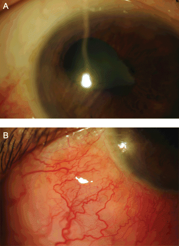 FIGURE 1  (A) External photo of the cornea and conjunctiva showing inferotemporal injection, keratic precipitates, anterior chamber cell and flare, and nasal synechiae. (B) External photo of the inferotemporal bulbar conjunctiva with injection and chemosis.