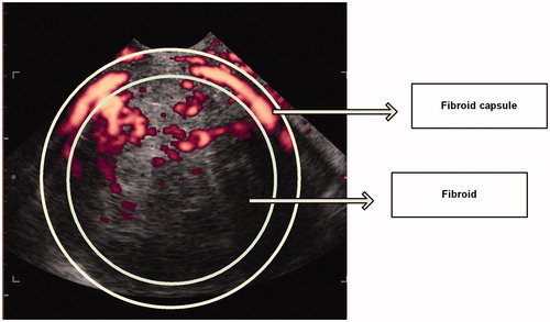 Figure 2. 3D power Doppler image: well vascularised fibroid, moderate peripheral penetration.