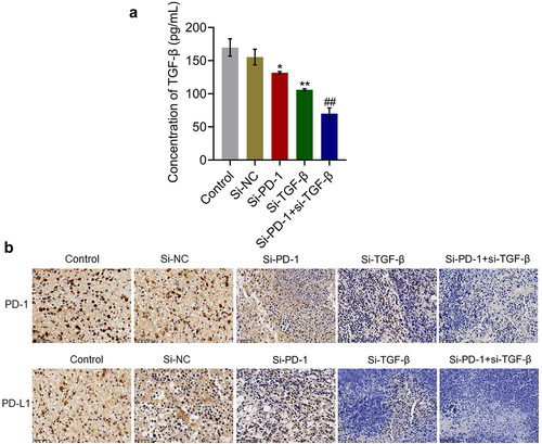 Figure 6. TGF-β and PD-1/PD-L1 were suppressed by si-PD-1 and si-TGF-β in tumor tissues. H22 cells treated with blank medium, si-NC, si-PD-1, si-TGF-β, and si-PD-1 + si-TGF-β were transplanted into mice to establish the xenograft animal model; when the tumor size reached 100 mm3, RFA was performed. A. The release of TGF-β in tumor tissues was measured by ELISA. B. The expression levels of PD-1 and PD-L1 were determined by immunohistochemical assay (*p < 0.05 vs. si-NC, **p < 0.01 vs. si-NC, ##p < 0.01 vs. si-PD-1).