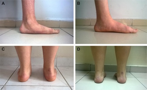 Figure 2 Preoperative and postoperative images of the patients in standing foot posture.