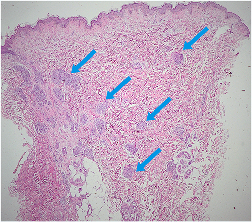 Figure 1 Histopathological examination from purplish red plaques on the chest showed lobules of tufts with a “cannon ball” appearances in the dermis (blue arrows) (Hematoxylin-eosin stain, 20x magnification).