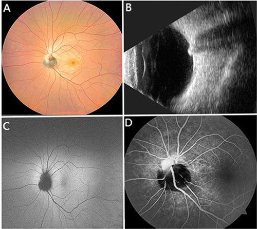 Figure 1 CFP showing a optic disc melanocytoma with black to dark brown slightly elevated mass lesion of the left optic disc. (A) B-scan ultrasonography of the left eye showing a hyperechoic small dome shaped lesion. (B) FAF revealed a totally hypofluorescent mass. (C) FA showed the hyperfluorescence staining of PHOMS at the superonasal rim of the left optic disc and diffuse blocked hypofluerescence in ODMC (D).