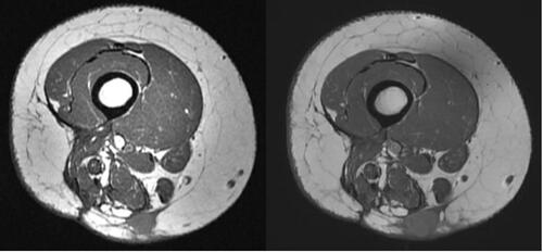 Figure 2 T1-weighted MRI showing interval enlargement of posterior thigh mass from 1.6 by 1.4 cm (left image) to 2.2 by 1.6 cm (right image), images were taken approximately 6 months apart.