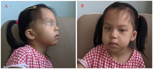 Figure 3. Facial features of the female proband. Lateral view (A) and frontal view (B) showing facial dysmorphism.