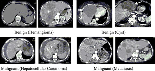 Figure 1. Liver tumor CT Dataset images.