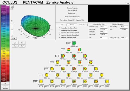 Figure 4 One-year postoperative aberration map showing improvement in most of the studied aberrations when compared with Figure 2.