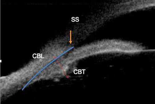 Figure 1. Figure depicting ciliary body length (CBL) and ciliary body thickness (CBT). SS: scleral spur.