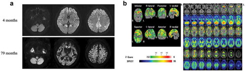 Figure 1. Magnetic resonance imaging (MRI) and single photon emission computed tomography (SPECT) of the patient. (a) Images from follow-up diffusion-weighted MRI 79 months after the onset revealed that atrophy of the brainstem was not apparent. However, the severe cerebrum atrophy was found. (b) SPECT images at 79 months after the onset revealed decreased regional cerebral blood flow (rCBF) in the bilateral frontal and parieto-temporal lobes; however, rCBF was preserved in the brainstem and cerebellum. The eZIS analysis of 99mTc-ECD SPECT images revealed decreased rCBF. A higher Z-score indicates a lower rCBF. The Z-score of 2 to 6 is indicated by the green to red (lower rCBF) colour gradient.