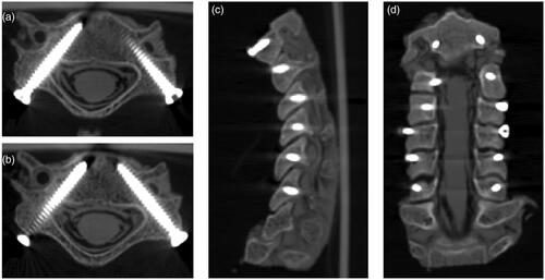 Figure 7. Postoperative CT scan showed positions of cervical pedicle screws with the assistance of two-level navigation template. (a) C5 pedicle screws classified as Grade 2 (left) (axial plane). (b) C5 pedicle screws classified as Grade 0 (right) (axial plane). (c) C2–C7 pedicle screws from sagittal plane. (d) C2–C7 pedicle screws from coronal plane.