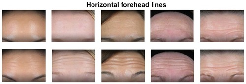 Figure 1 Region 1 (forehead and brows) showing glabellar frown lines in relaxed and contracted state.