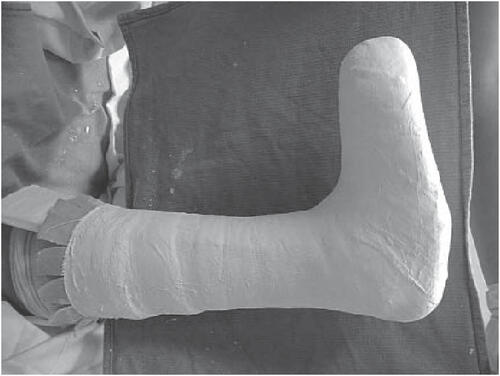 Figure 6 Total contact cast.