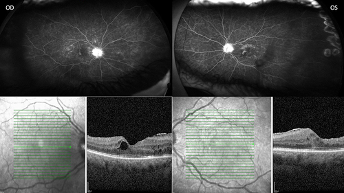 Figure 2 Persistent inflammation 6 weeks after Ozudex OD and 8 weeks after Ozurdex OS, widefield fluorescein angiography (Optos) and optical coherence tomography. Bright green line indicates section of image provided and green arrow has no significance.
