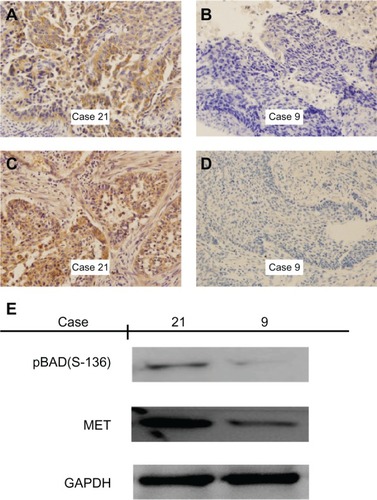 Figure 1 Immunohistochemical staining and Western blotting for MET and phospho-BAD(Ser-136) in squamous cell carcinoma of the lung. (A and B) Positive and negative staining of MET in squamous cell carcinoma. Case 21 shows strong cytoplasmic/membrane staining, whereas case 9 shows only weak cytoplasmic staining. (C and D) Positive and negative staining of phospho-BAD(Ser-136) in squamous cell carcinoma. Case 21 shows strong cytoplasmic staining, whereas case 9 shows only weak cytoplasmic staining. (E) Western blotting with MET and phospho-BAD(Ser-136) expression in cases with squamous cell carcinoma of the lung, indicating increased phospho-BAD(Ser-136) detection in the case with positive expression of MET by immunohistochemistry. Magnification ×400.