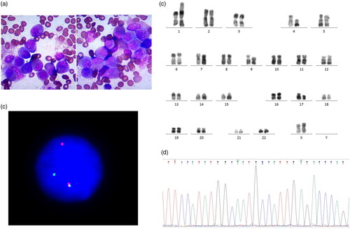 Figure 1. (a) Bone marrow aspirate showed promyelocytes with regular nuclei and no Auer rods. (b) Dual-color fluorescence in situ hybridization (FISH) with 3′-RARA (green signal) and 5′-RARA (red signal), was performed for nuclei of 500 leukemia cells in interphase. The normal RARA gene shows as a superimposed yellow or red-green signal. FISH showed a 70% split signal, indicating rearrangement of RARA. (c) Karyotype: 46,XX,t(1;17;4)(p36;q21;q12),der(9)[20]. (d) Sequencing analysis indicating a FIP1L1-RARA fusion transcript using reverse transcription polymerase chain reaction.