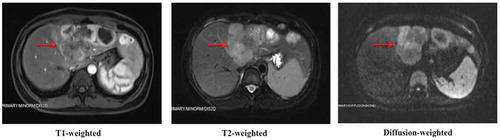 Figure 1. Multiple masses in the left lobe of liver revealed by abdominal enhanced MRI in November 2017.