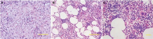 Figure 2 (A) Pathocytology of esophageal tissue revealed squamous cell carcinoma. (B and C) Pathocytology of pleural soft tissue showed a few of lymphocytes, erythropoiesis, megakaryocytes, and degraded cells.Notes: (A and B) H&E staining ×100. Scale bar: 100 µm and (C) H&E staining ×200. Scale bar: 100 µm.Abbreviation: H&E, hematoxylin and eosin.