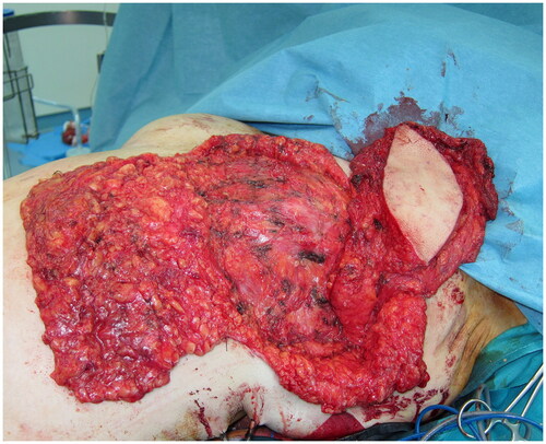 Figure 3. Intraoperative view of the fat-augmented latissimus dorsi (FALD) flap after the fat injections into the LD flap, the left pectoralis major muscle, the mastectomy skin flaps and the de-epithelialized dermo-fatty pedicle of the lower breast pole.