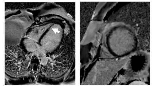 Figure 2C After 12 months, further reduction of the basal septal late enhancement area was present, however there is persisting late enhancement in the apical septum with wall thinning.