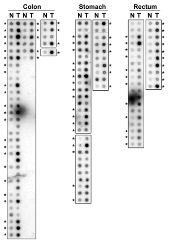 Figure 2 PDRG mRNA is overexpressed in human malignancies. Representative results showing PDRG expression in primary gastrointestinal tract tissue specimens. RNA samples representing matching normal (N) and tumor (T) specimens from colon, stomach and rectum were probed with PDRG cDNA probe as described in Material and Methods. Each pair indicates normal and tumor samples from a single patient. *Indicates higher PDRG mRNA level in tumor sample than that in the matching normal tissue sample.