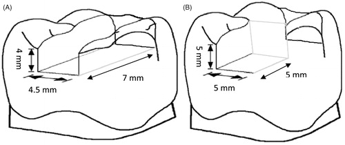 Figure 1. Schematic representation of Class II (A) and onlay (B) preparation measurements in mm.