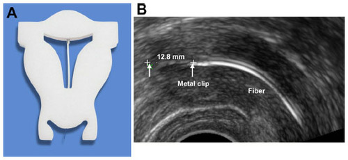 Figure 1 FibroPlant® levonorgestrel-releasing intrauterine system.