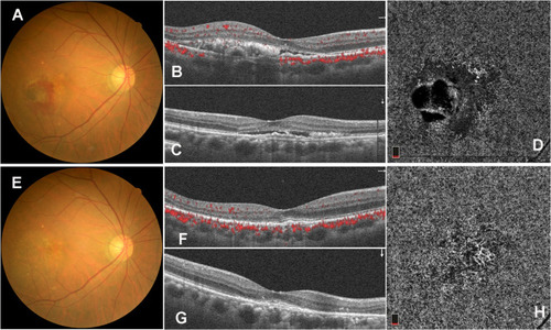 Figure 4 Fudus imaging of nAMD patient 2 before and after IVR. Subretinal hemorrhage and exudation on colour photography (A), optical coherence tomography (B and C) and optical coherence tomography angiography showing choroidal new vessels before IVR (D). Subretinal hemorrhage and exudation was decreased on colour photography (E), optical coherence tomography (F and G) and optical coherence tomography angiography showing choroidal new vessels were shrinked after IVR (H).