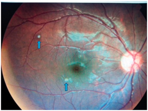 FIGURE 3. Right eye fundus photo revealing scarred multifocal choroiditis (arrow pointing to the lesions), post intravenous antifungal completion.