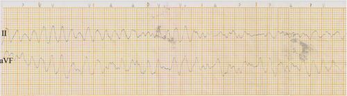 Figure 4 The records for the patient are shown in Figure 3. When he returned to the CCU after the procedure, ventricular arrhythmia was noted, and he was shocked immediately. He declined an ICD implant and requested discharge 7 days later.