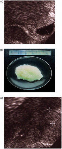 Figure 3. Vaginal ultrasound. (a) Uterus with an intrauterine pregnancy corresponding to 6 weeks after the last menstrual period, with yolk sac visible and serum hCG 32,000 IU/l. (b) Gestational sac of the same woman expelled on day 3. (c) Uterine cavity diameter 12 mm in the same woman 8 days after intake of mifepristone in an MToP procedure. Serum hCG had dropped to 837 IU/l. The gestational sac that was visible in the uterine cavity prior to the procedure is gone.