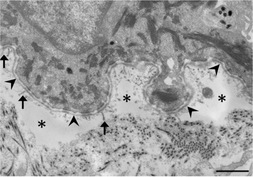 Figure 2 Electron microscopic image of dystrophic epidermolysis bullosa.