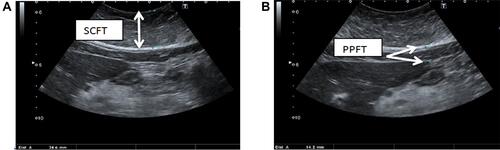 Figure 1 Abdominal ultrasound examination showing (A) subcutaneous fat thickness (SCFT), which is approximately 34.6 mm; (B) the preperitoneal fat thickness (PPFT), which is approximately 14.2 mm.