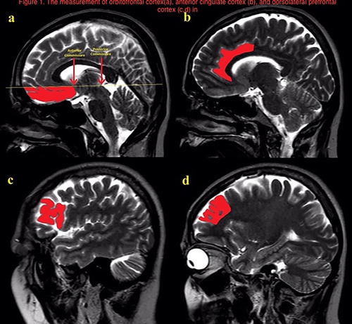 Figure 1. The measurment of orbitofrontal cortex (a), anterior cingulate cortex (b), and dorsolateral prefrontal cortex (c,d) in sagittal T2 images.