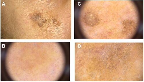 Figure 2 Case presentation 2. (A) clinical presentation, (B) dermoscopic picture of solar lentigo, (C) dermoscopic picture of seborrheic keratosis, (D) dermoscopic picture of the lentigo malignant melanoma.