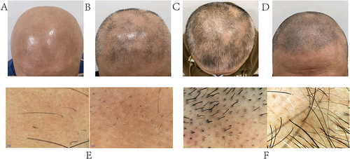 Figure 1 Photos of Patient 1’s hair and skin under the dermoscope. (A-D) These photos were taken before treatment, 1 month, 2 months and 3 months after treatment. It can be seen that the patient’s hair is gradually growing back and the area of hair loss is gradually decreasing in size. (E and F) These photographs were taken under a dermatoscope before and 2 months after treatment, showing the patient’s hair regrowth post-treatment.