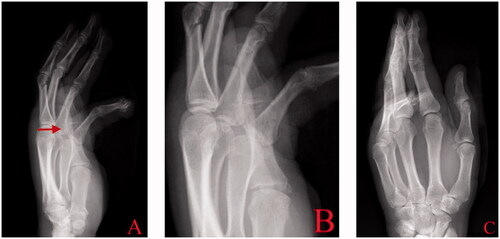 Figure 1. Injury radiographs anteroposterior and lateral of hand (A, C) with focus on thumb (B) demonstrate a condylar fracture of proximal phalangeal head (arrow).