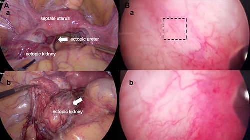 Figure 3 Intraoperative endoscopic data. (A) (a) Laparoscope showed septate uterus. A retroperitoneal cyst was dissociated from left ovary and fallopian tube. (b) The mass, probably be an ectopic kidney (arrow), was separated from surrounding tissue, and the distal end extended to nearby bladder. (B) Cystography imaging showed right ureter opening (dotted box) in bladder (a), but detected no left ureter opening (b).
