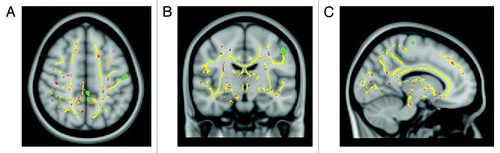Figure 2. TBSS results and SPM-VBM analysis of cortical brain volume from 15 RR-MS patients and 15 healthy controls displayed on the Montreal Neurological Institute template. Clusters of reduced FA in patients compared with healthy controls are indicated in red. Areas of significant reduction of gray matter volume in patients compared with healthy controls are indicated in green.