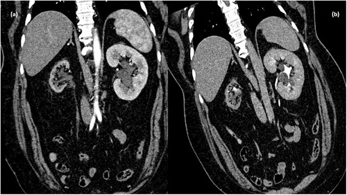 Figure 1. CT scan arterial phase in coronal plane showing non enhancing collection in peripelvic region of left kidney (d) MPR reformation of coronal plane of delayed phase of CT scan abdomen showing normal excretion of contrast with no evidence of leakage in PC system – unilateral peripelvic lymphangiectasia.