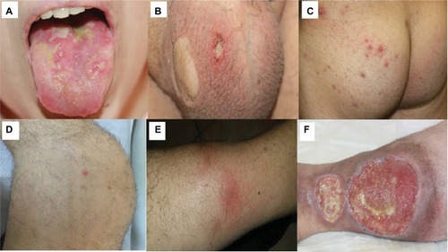 Figure 1 Mucocutaneous lesions of Behçet’s syndrome.