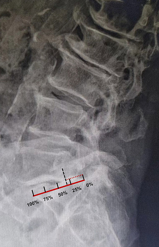 Figure 5 Preoperative Lateral X-ray of the standing lumbar spine illustrating the degenerative lumbar isthmic spondylolisthesis with Meyerding Grade II, along with the measurement of slippage percentage.