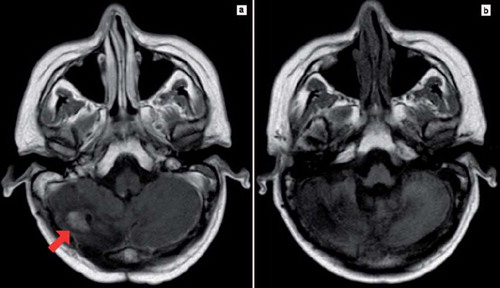 Figure 1. Magnetic resonance showed (a) cerebellar relapse after consolidation therapy and (b) complete response after fotemustine salvage therapy.