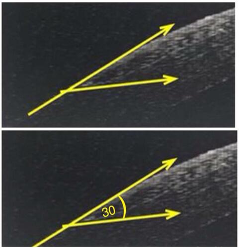 Figure 4 Microkeratome LASIK flap with acute side-cut angle 30°. Abbreviation: LASIK, laser-assisted in situ keratomileusis.