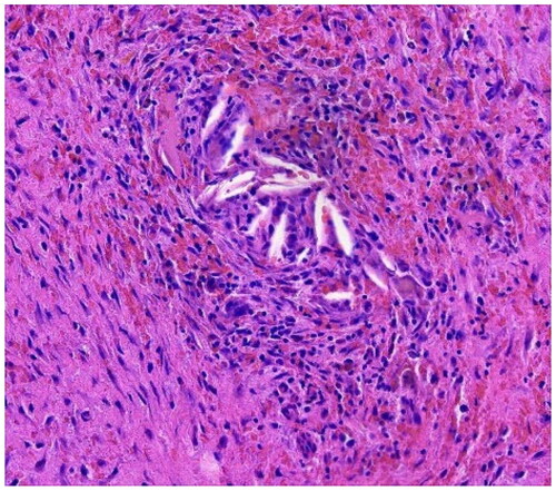 Figure 6. Pathological tissue shows a large number of inflammatory cell infiltrates and cholesterol crystals. Hematoxylin-eosin staining 100.